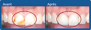 photos avant et après facettes dentaires