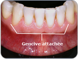 Gencive attachée