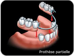 Prothèse partielle
